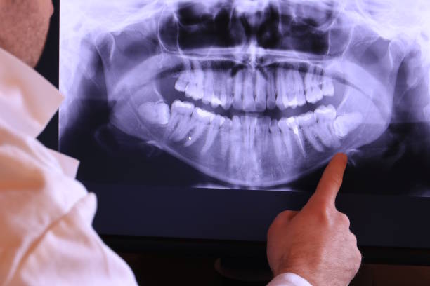 Best Emergency Dentist for Lost Fillings or Crowns in Blauvelt, NY