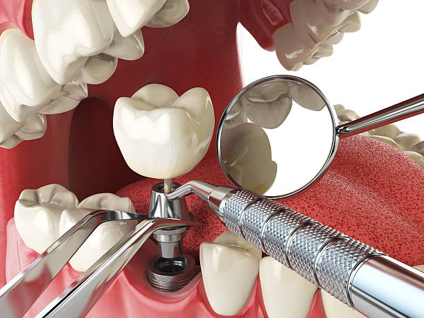 Best Broken or Cracked Tooth Emergency Dentist in Blauvelt, NY